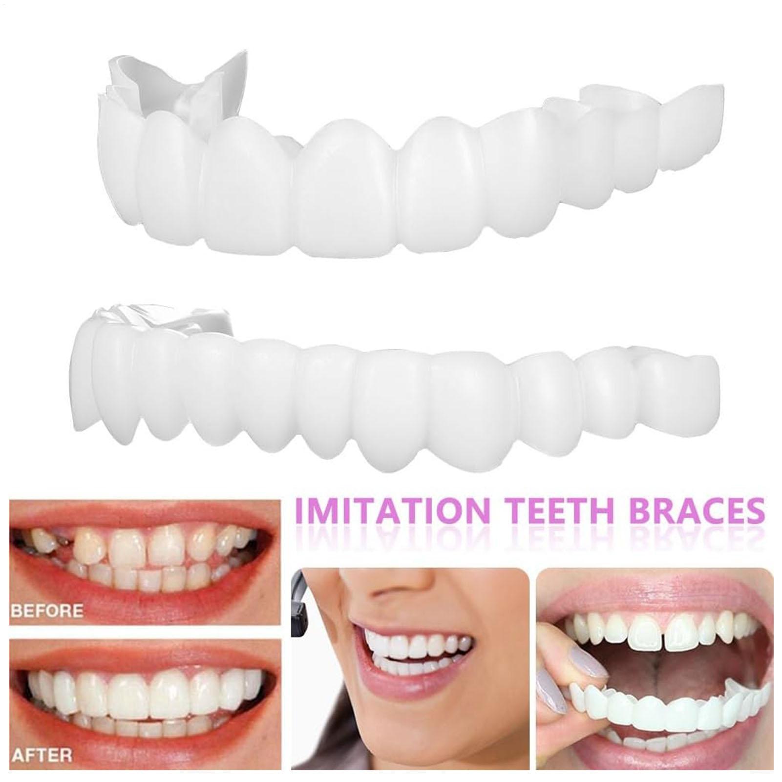 Teeth Whitening Veneers - Copertura Dentale Superiore e Inferiore per