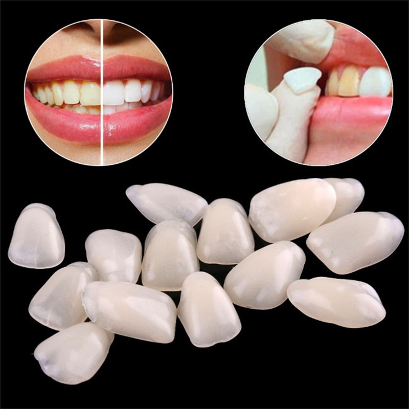 Teeth Whitening Veneers - Impiallacciature dentali temporanee: coperture per denti