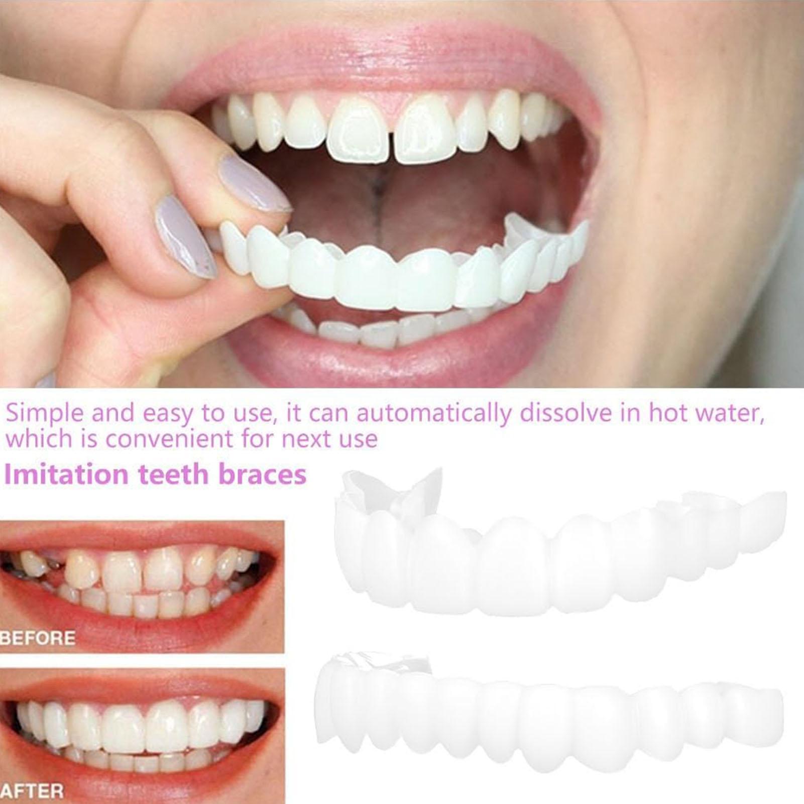 Copertura Dentale Superiore e  - Teeth Whitening Veneers recensione e prezzo