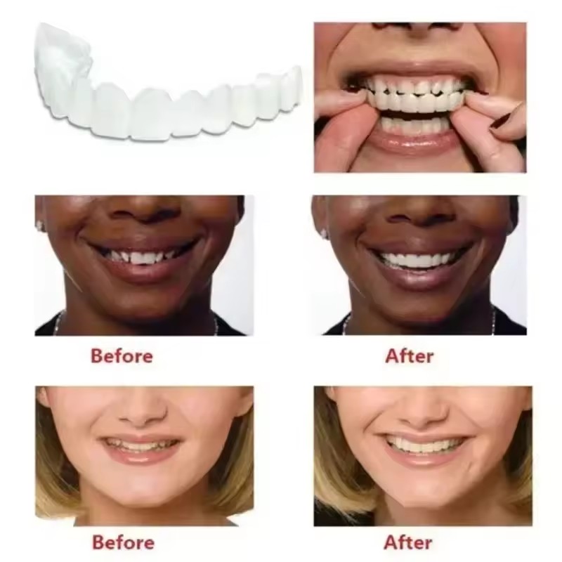 Faccette Dentali Sbiancanti, P - Teeth Whitening Veneers recensione e prezzo